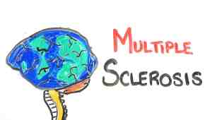 Multiple Sclerosis